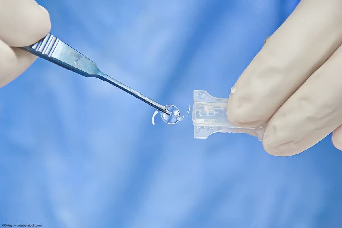 Multifokal göz içi lensin enjektöre yüklenmesi