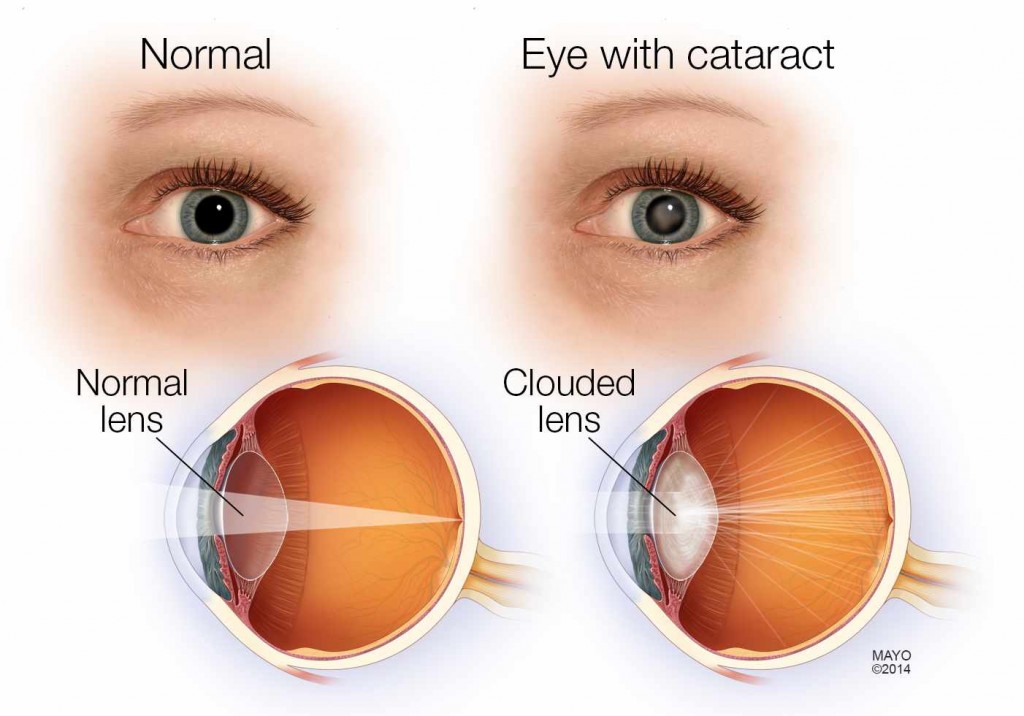 cataract-1024x716